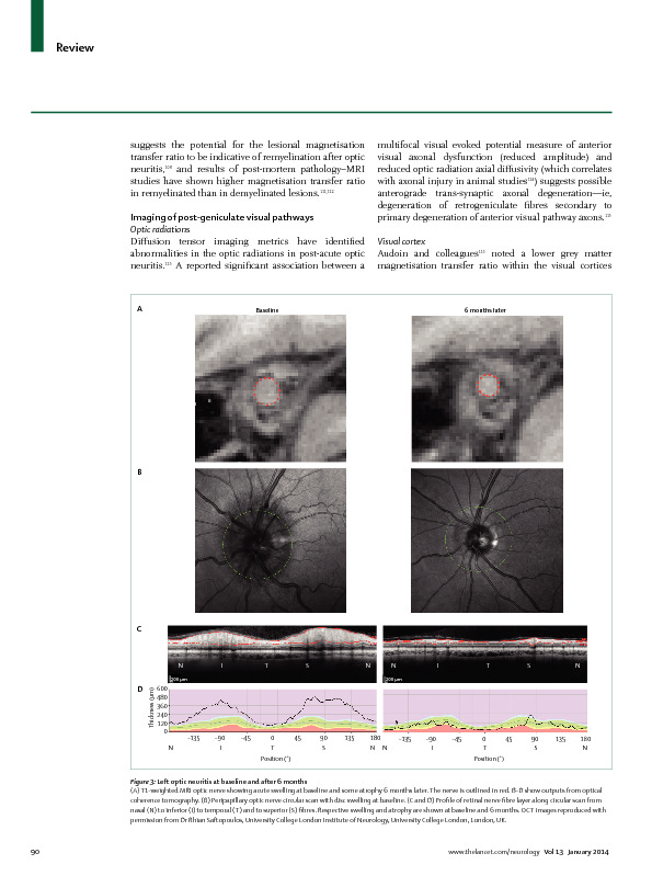 Download Optic neuritis.
